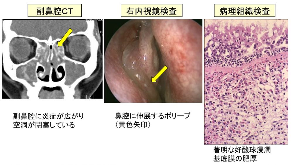 好 酸 球 性 副 鼻腔 炎 治っ た ブログ