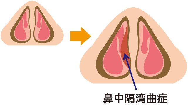 鼻中隔が弯曲する原因