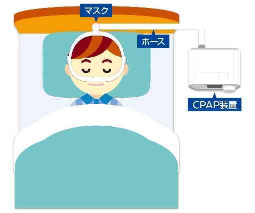 CPAP療法