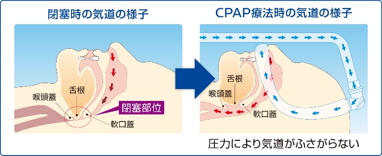 CPAP療法